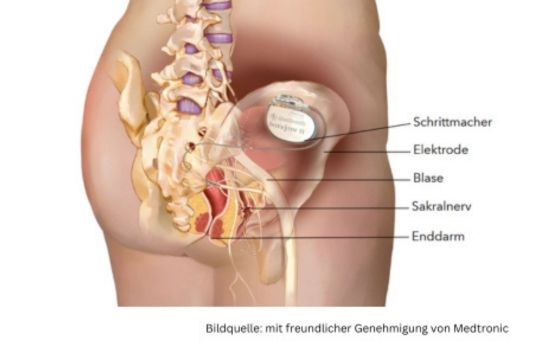 sakrale Neuromodulation